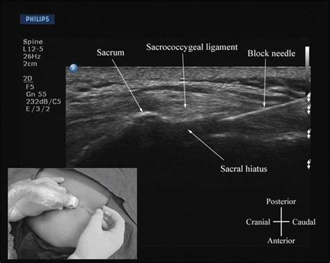 sacroiliac spine ultrasound